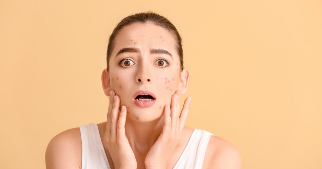 Salicylic Acid for Acne-Prone Skin